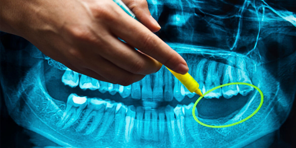 The Benefits & Importance of Dental Implants