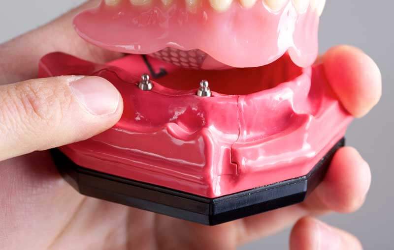 Mini dental implants in plastic model